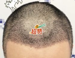 -大麦微针植发全国连锁