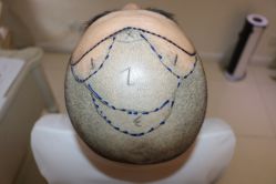 -大麦微针植发丨全国连锁