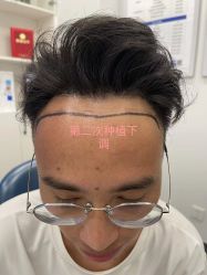 体验前-大麦微针植发全国连锁
