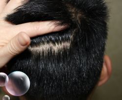 -大麦微针植发丨全国连锁