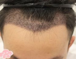 -大麦微针植发丨全国连锁