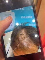 -碧莲盛·不剃发植发