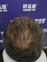 -碧莲盛·不剃发植发