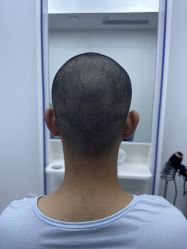 -大麦微针植发全国连锁