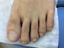 -德哥灰指甲脚气甲沟炎跖疣护理