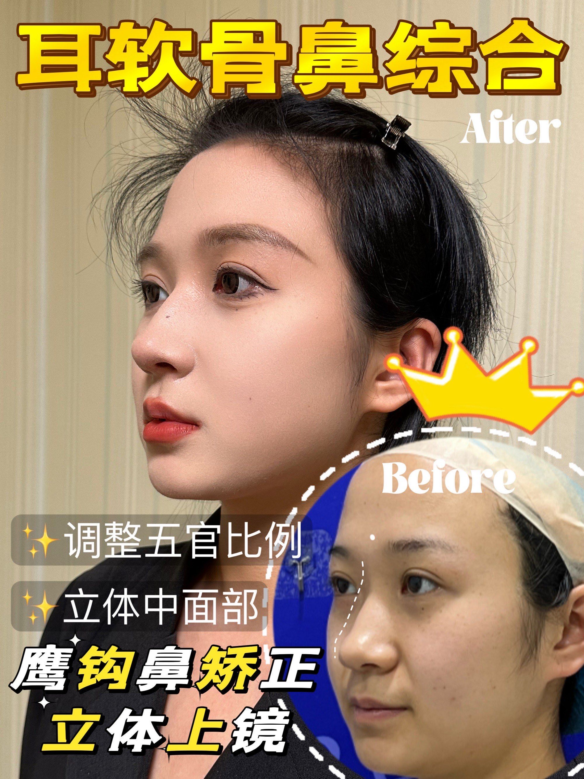 鹰钩鼻矫正成功[胜利]