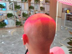 -碧莲盛·不剃发植发
