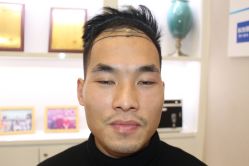 -大麦微针植发丨全国连锁