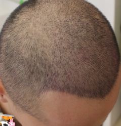 -大麦微针植发丨全国连锁