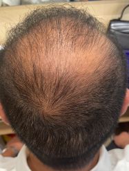 -碧莲盛·不剃发植发