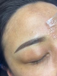 体验后-郡艺医疗美容·微整·眼鼻吸脂