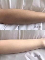 -HEYAN荷妍专业脱毛连锁机构