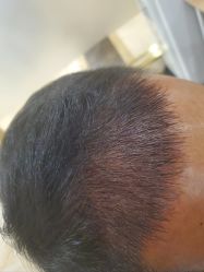 -碧莲盛·不剃发植发