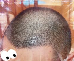 -大麦微针植发全国连锁