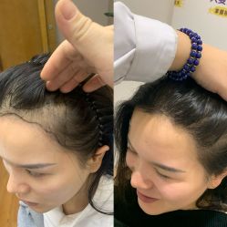 -大麦微针植发全国连锁