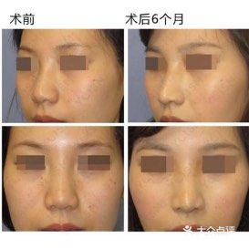 日本整形|关于隆鼻的那些事