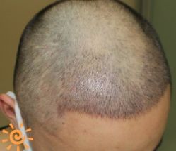 -大麦微针植发丨全国连锁