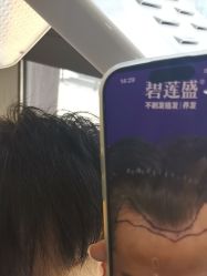 -碧莲盛·不剃发植发