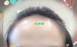 -大麦微针植发全国连锁