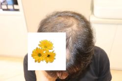 -大麦微针植发丨全国连锁