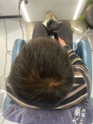 -大麦微针植发全国连锁