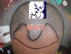 -大麦微针植发全国连锁