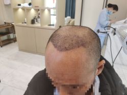 -大麦微针植发丨全国连锁