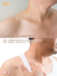 -清疣美疣·痣·斑净肤中心