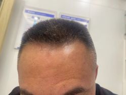 -大麦微针植发全国连锁