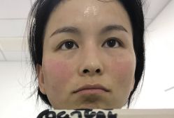 体验后-东剑医学美容·注射美学中心