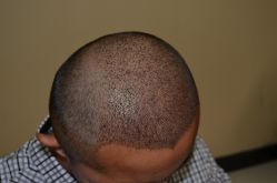 -大麦微针植发丨全国连锁