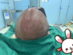 -大麦微针植发丨全国连锁