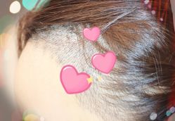 -大麦微针植发全国连锁