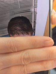 -大麦微针植发丨全国连锁