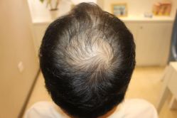 -大麦微针植发丨全国连锁