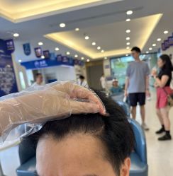 -大麦微针植发全国连锁