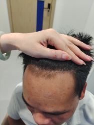 -大麦微针植发全国连锁