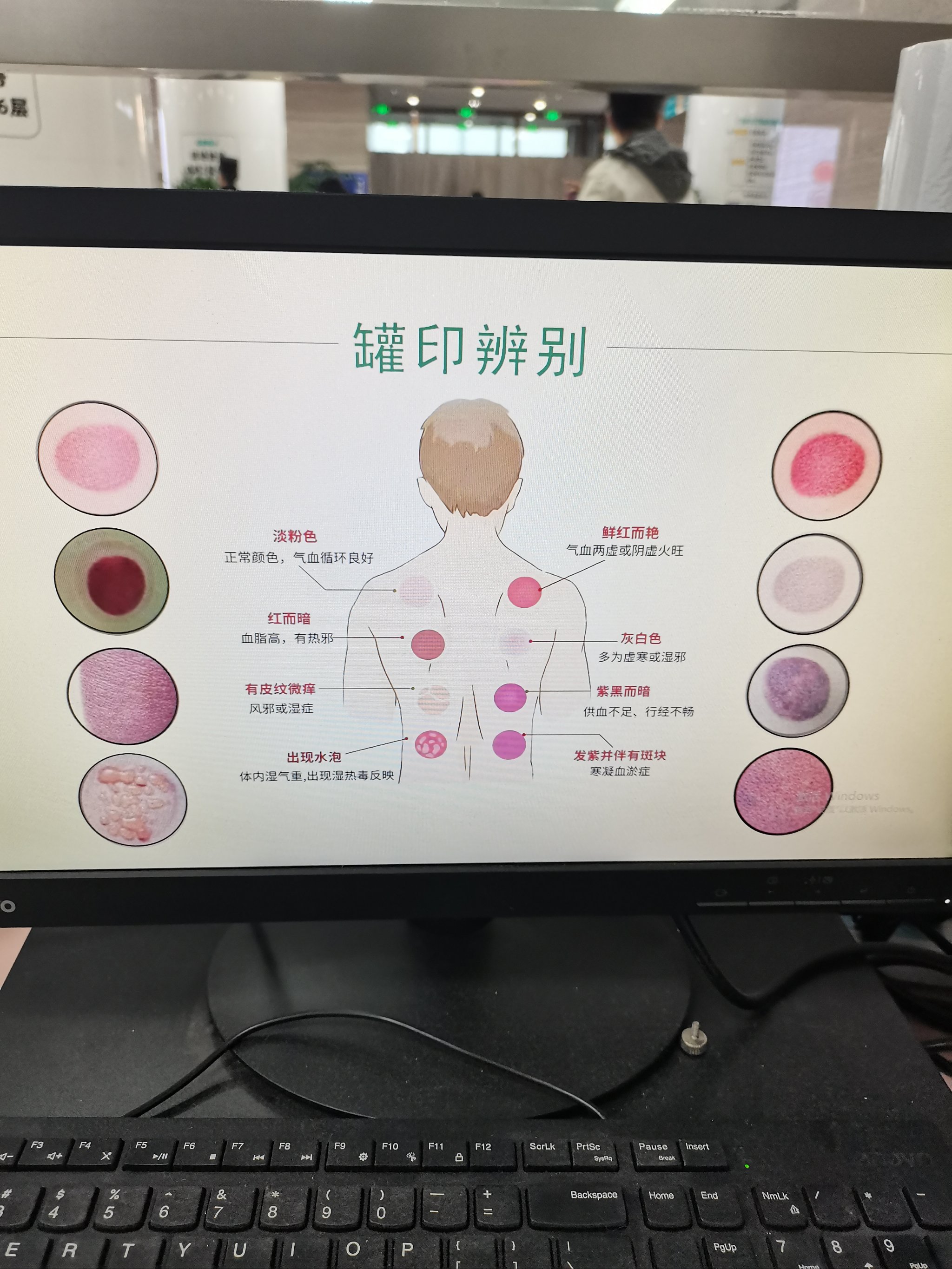 最美拔罐图片