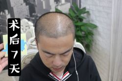 -大麦微针植发全国连锁