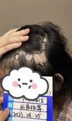 -大麦微针植发全国连锁