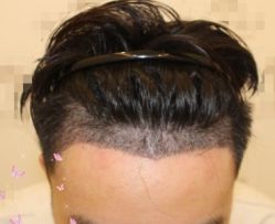 -大麦微针植发丨全国连锁