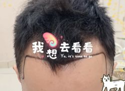 -大麦微针植发全国连锁