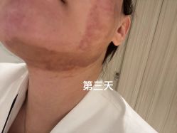 体验后-杭州米兰柏羽医疗美容医院