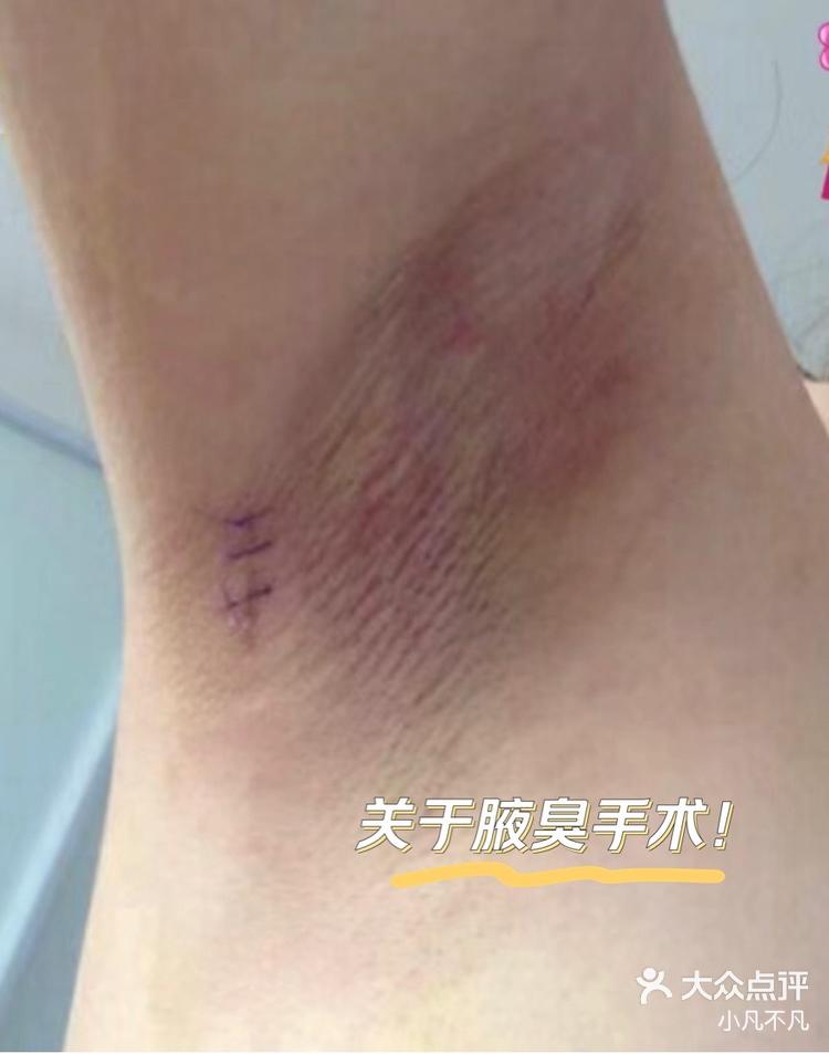 关于腋臭手术大家一定要知道