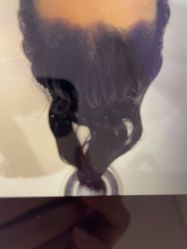 体验后-大麦微针植发全国连锁