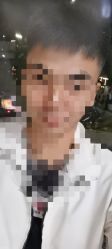 点击看大图 体验后-大麦微针植发全国连锁