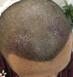 -大麦微针植发丨全国连锁