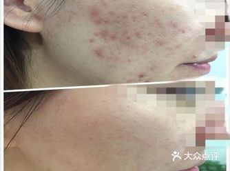 小仙女怎么能允许漂亮的脸上长痘痘呐！