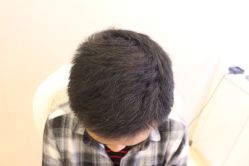 -大麦微针植发丨全国连锁