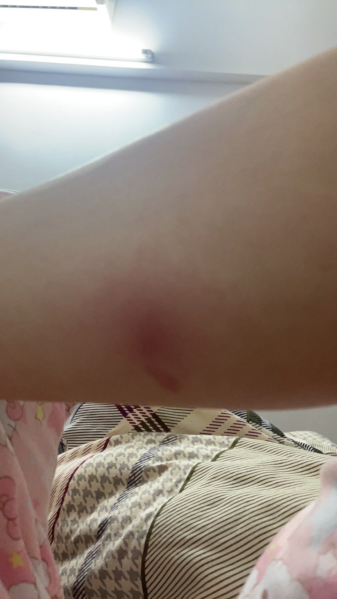 蚊子咬得又痛又痒